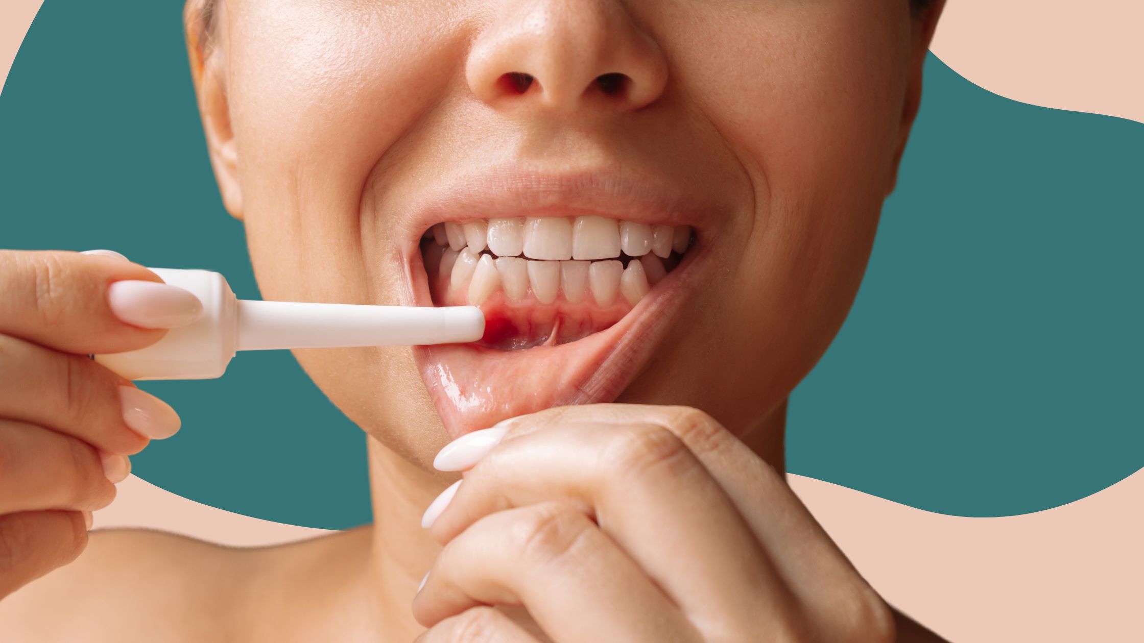 7 Home Remedies to Cure Mouth Ulcers Naturally