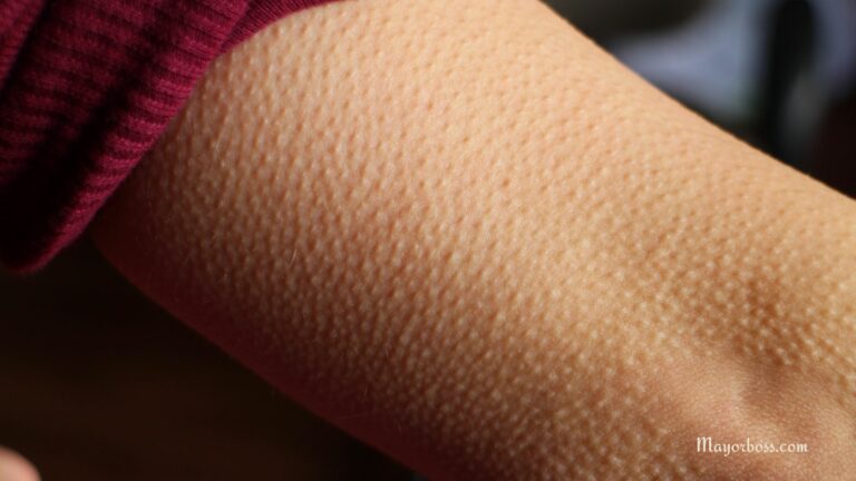 How to Get Rid of Goosebumps