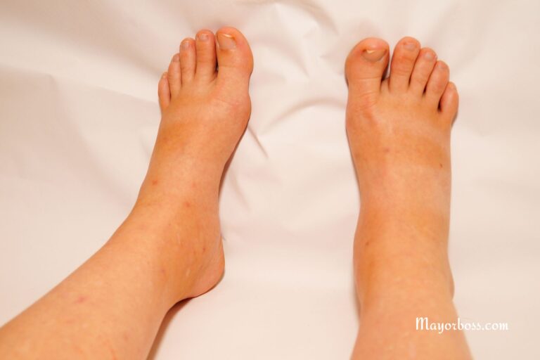 This Vitamin Can Reduce Swollen Legs and Ankles