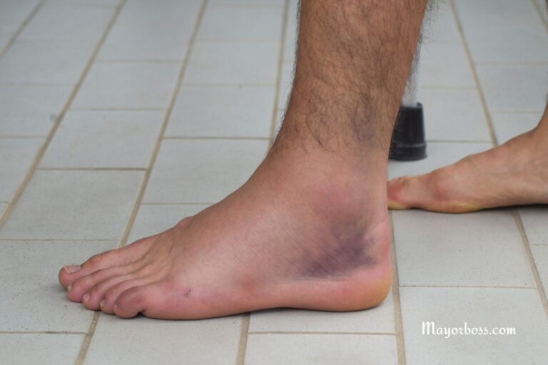 What Causes Purple Feet?