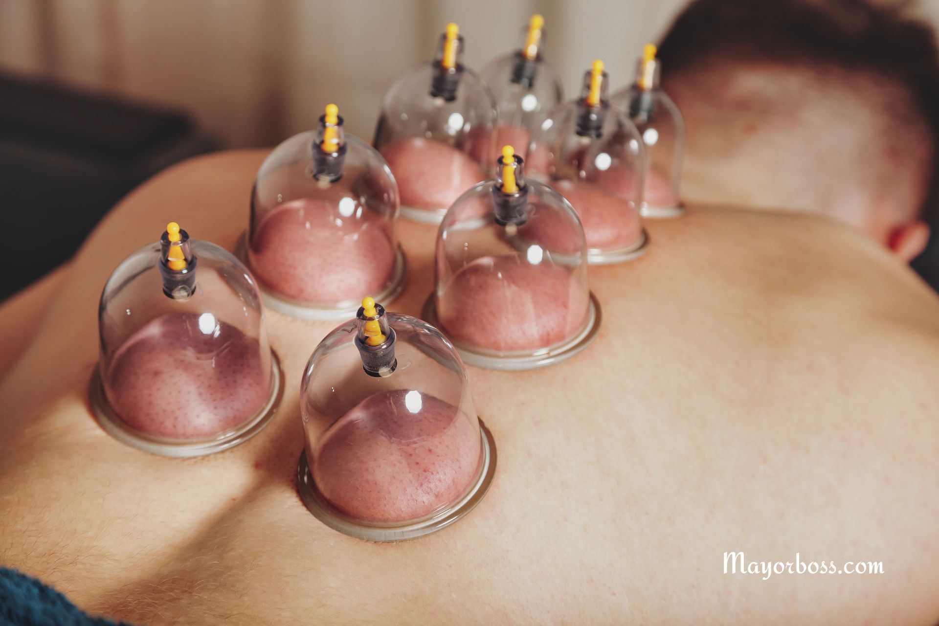 What Is Cupping? Here’s What You Need to Know