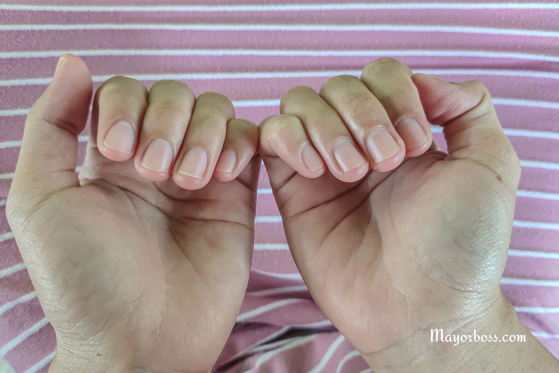 3 Ways Your Fingernails Might Show Signs of High Cholesterol