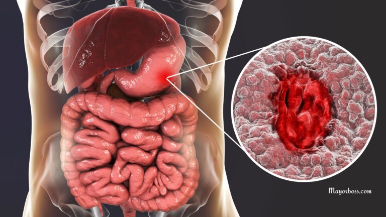 Everything You Need to Know About Stomach Ulcer