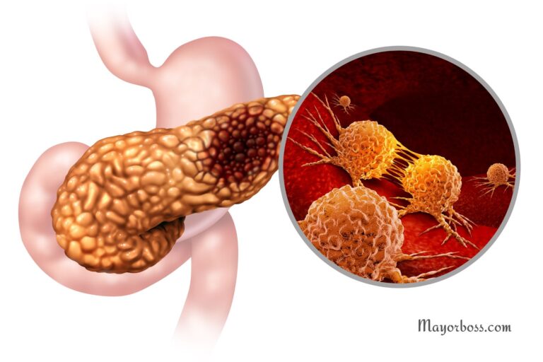 5 Warning Signs of Pancreatic Cancer