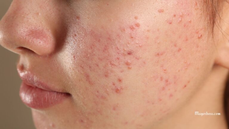 Stop Putting Up With Acne—Here’s How to Get Rid of It