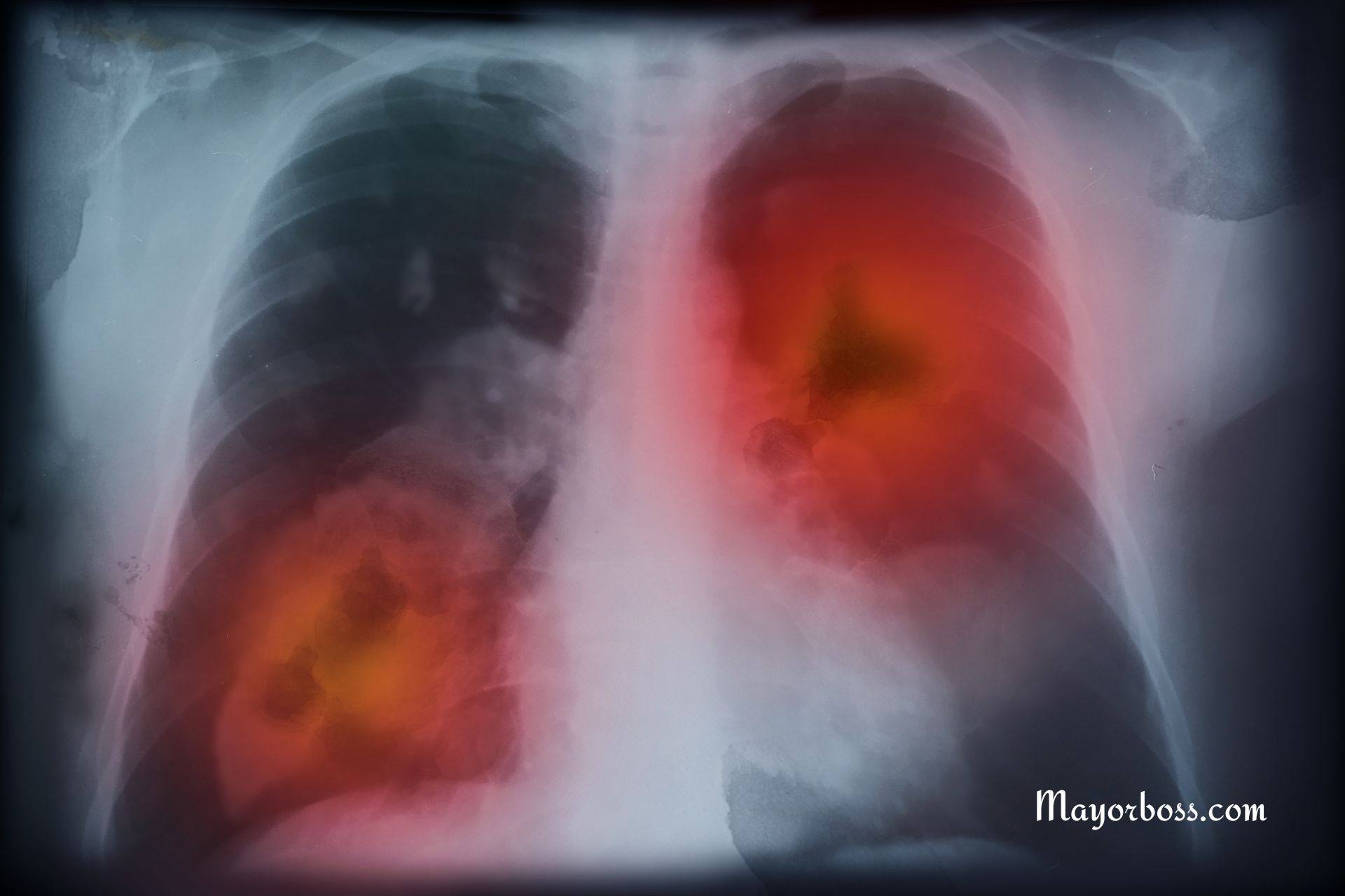 Early Lung Cancer: 10 Early Signs of Lung Cancer