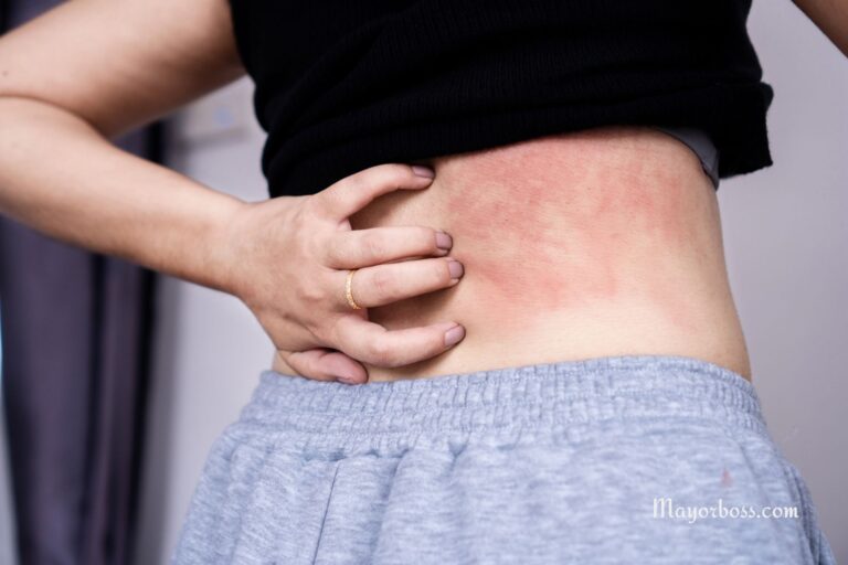 Science Says You Should Not Scratch Your Itchy Rash