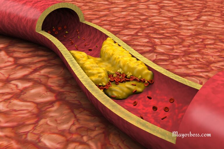 What It Means if You Have ‘Sticky’ Cholesterol