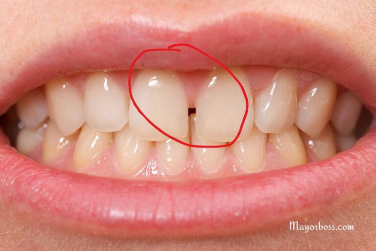What is Diastema? How to Fix Small Gap Between Your Front Teeth