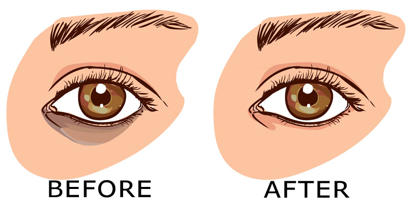 6 Remedies That Remove Dark Circles Fast