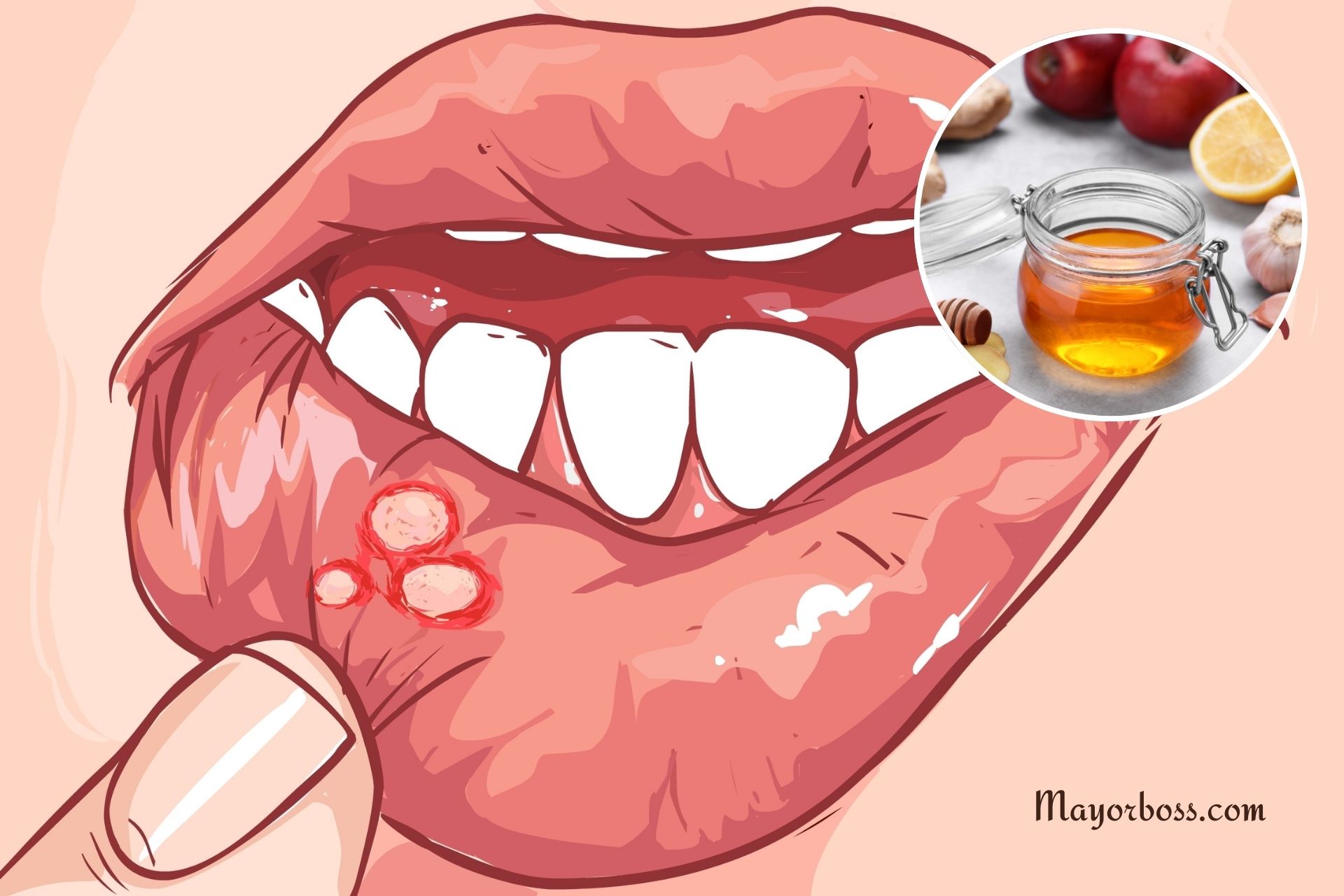 How to Get Rid of Canker Sores