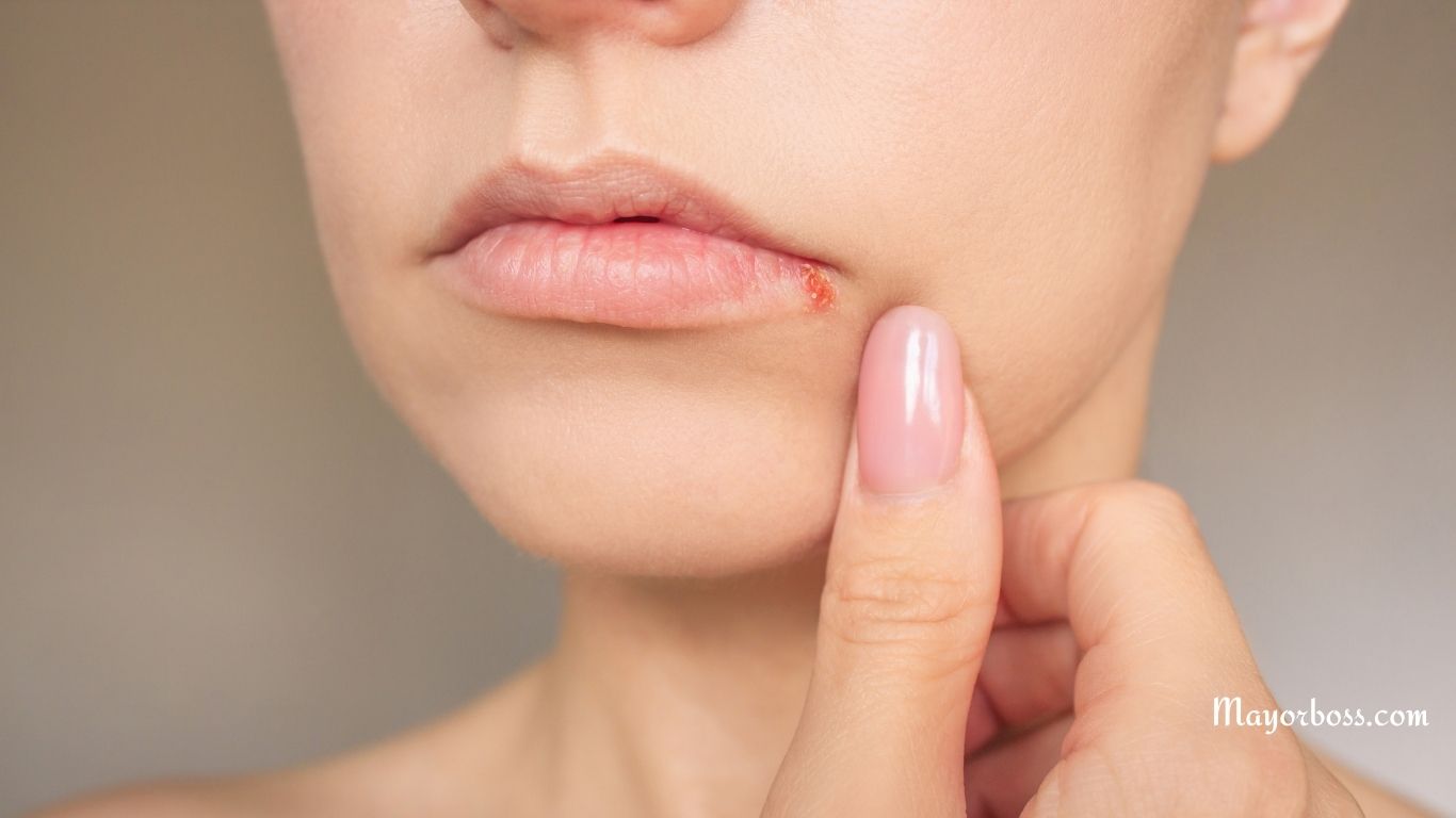 Here’s What’s Causing The Acne Around Your Mouth